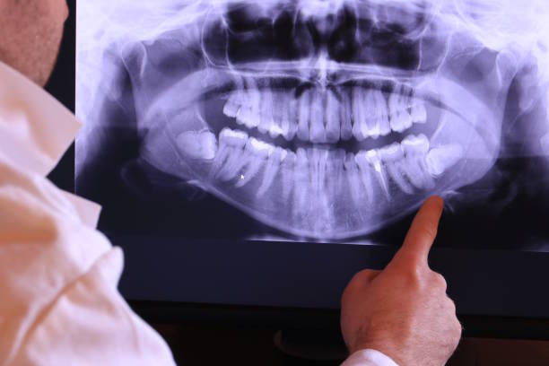 Best Emergency Wisdom Tooth Extraction in Hoosick Falls, NY