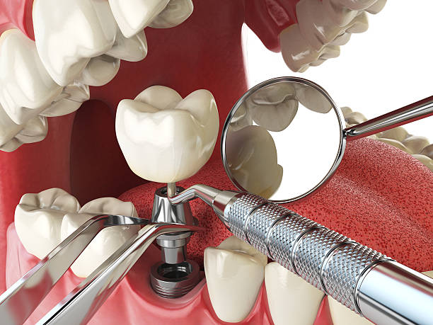 Best Knocked-Out Tooth (Avulsed Tooth) Treatment in Hoosick Falls, NY